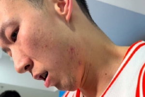 周琦谈夏天打针治疗腰伤：这次数量&剂量更大 目前来讲恢复得不错